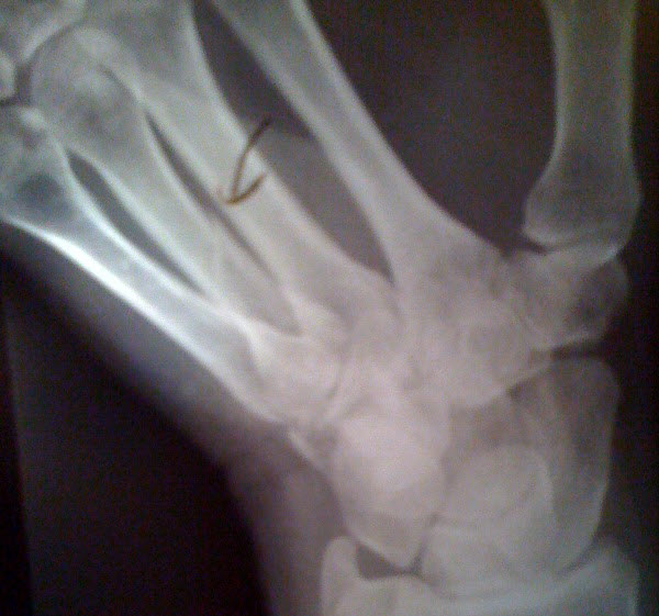 x-ray of hand